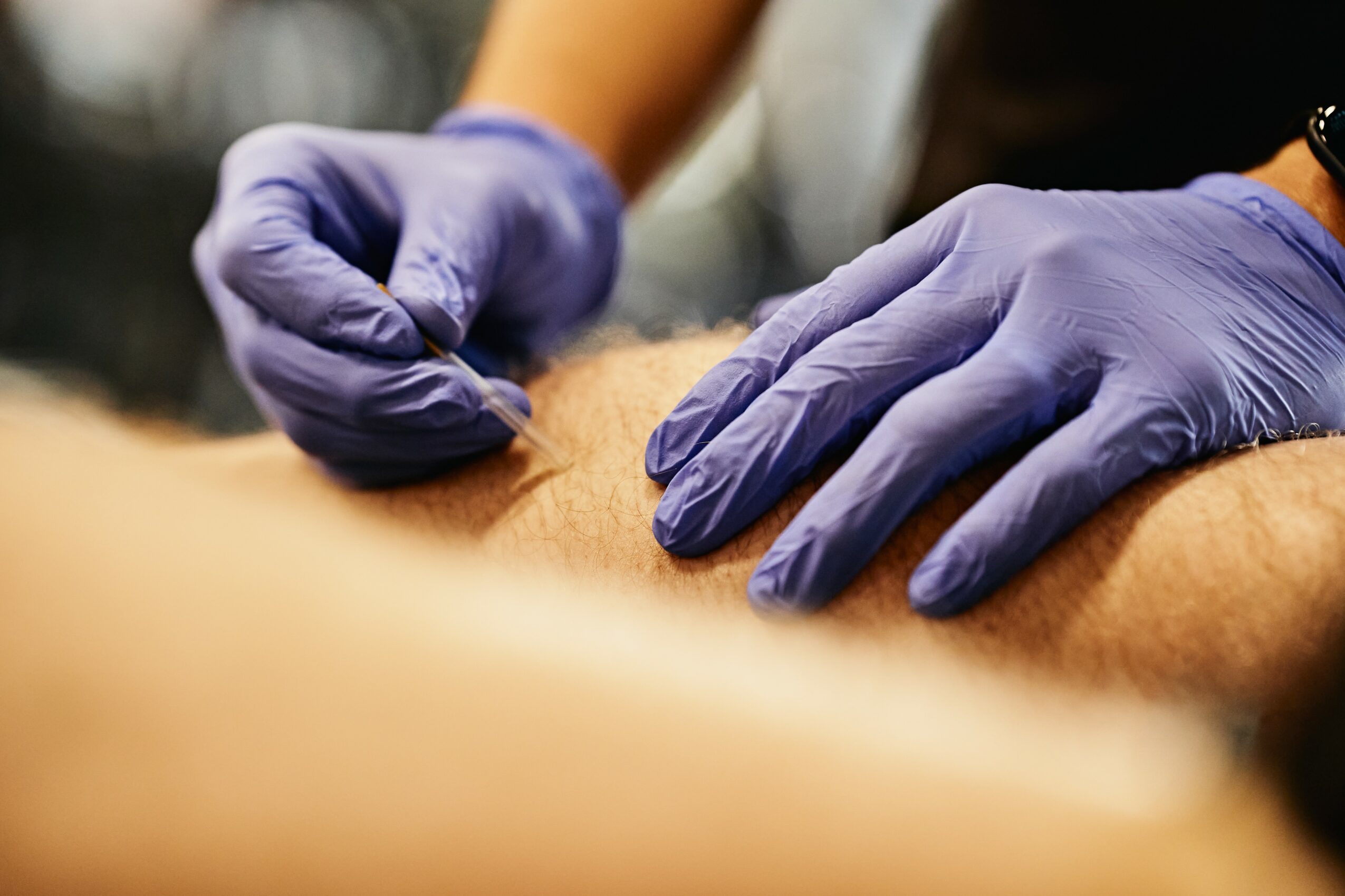 Person wearing purple gloves administering an injection into a person's arm.