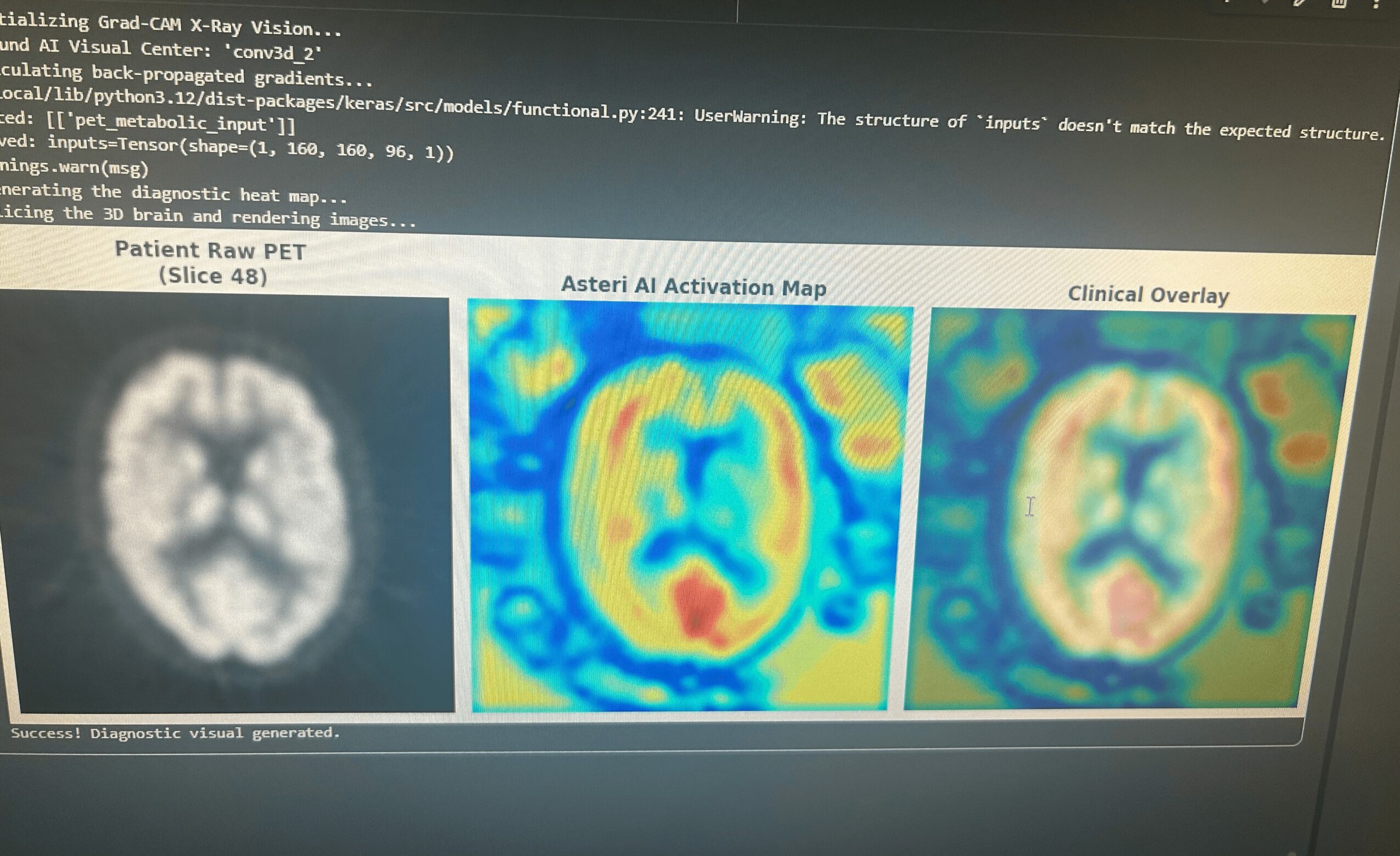 Brain scan with three images: PET scan, activation map, and clinical overlay, showing brain activity patterns.