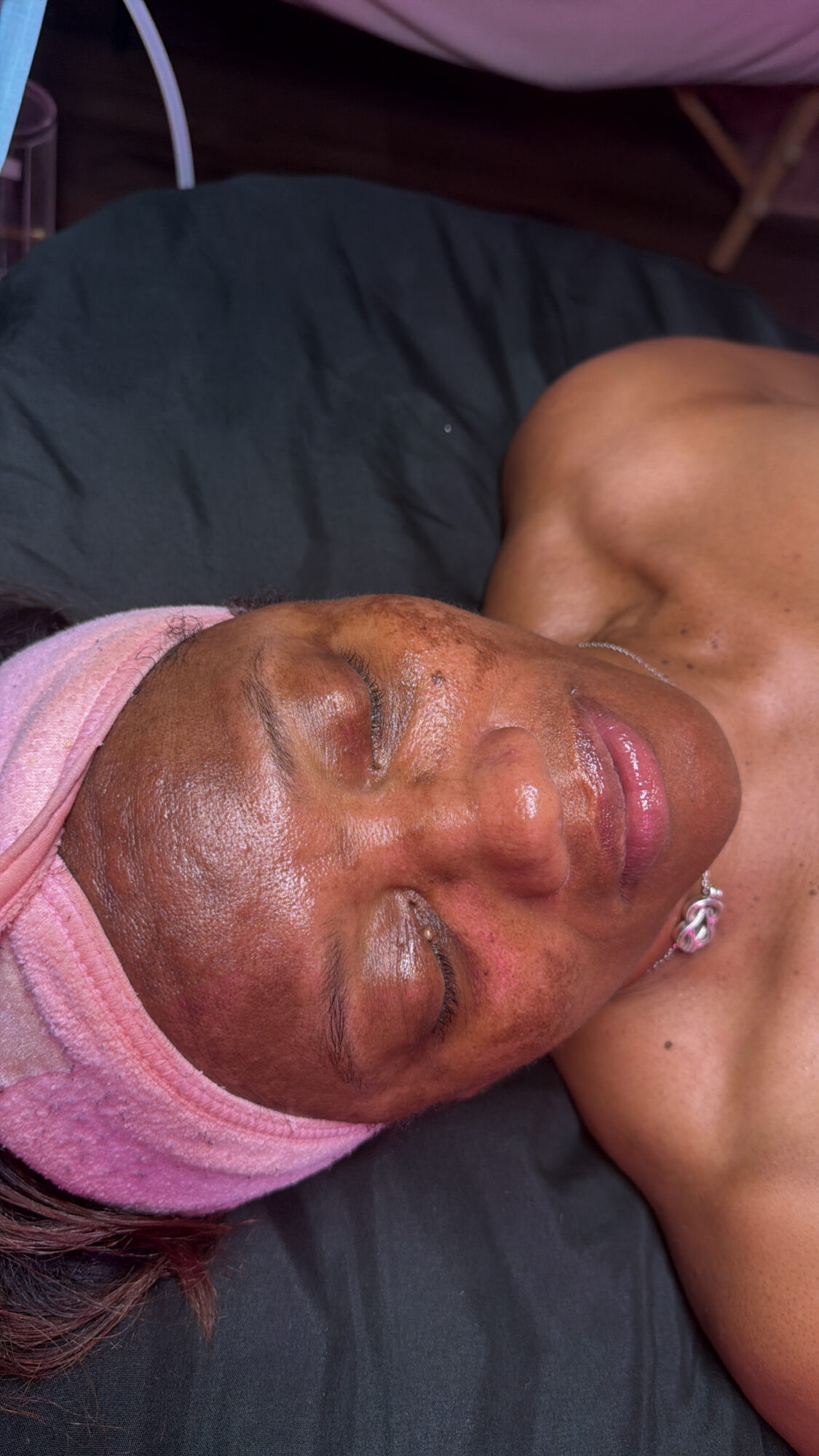 Person lying down with eyes closed, wearing a pink head covering, skin appears shiny and slightly swollen.